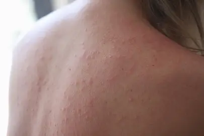 Woman injured back with rash and red sun spots. Sun allergy and skin burns concept