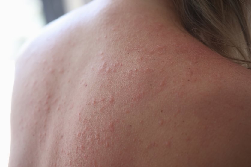 Woman injured back with rash and red sun spots. Sun allergy and skin burns concept